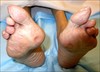 Foot_Wound