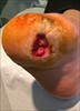 Foot_Ulcer_before